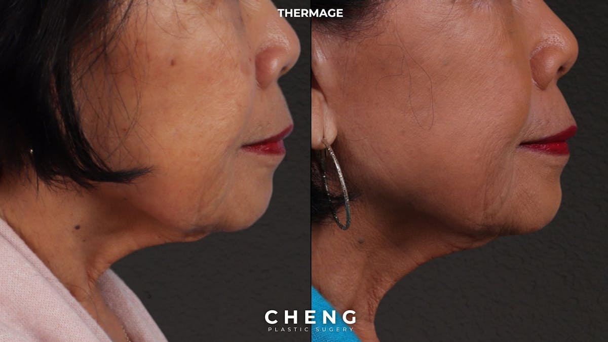 Thermage FLX  Before & After Gallery - Patient 368652 - Image 1