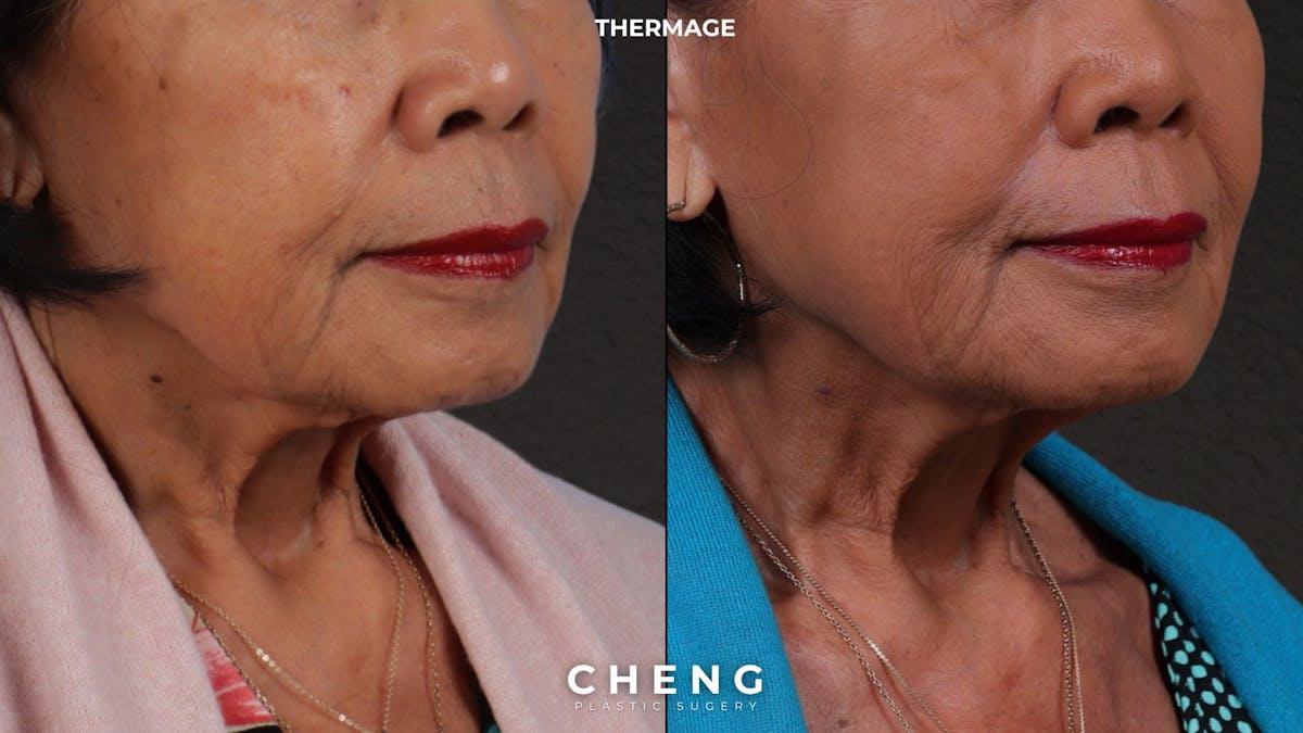 Thermage FLX  Before & After Gallery - Patient 368652 - Image 2