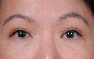Brow Lift Before & After Gallery - Patient 400205 - Image 2