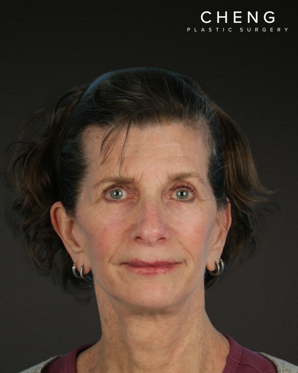Neck Lift Before & After Gallery - Patient 180677 - Image 2