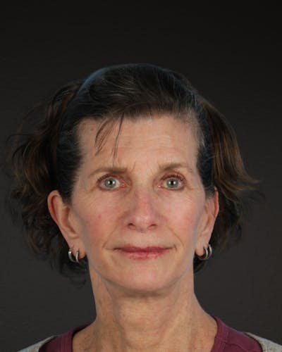 Neck Lift Before & After Gallery - Patient 180677 - Image 2