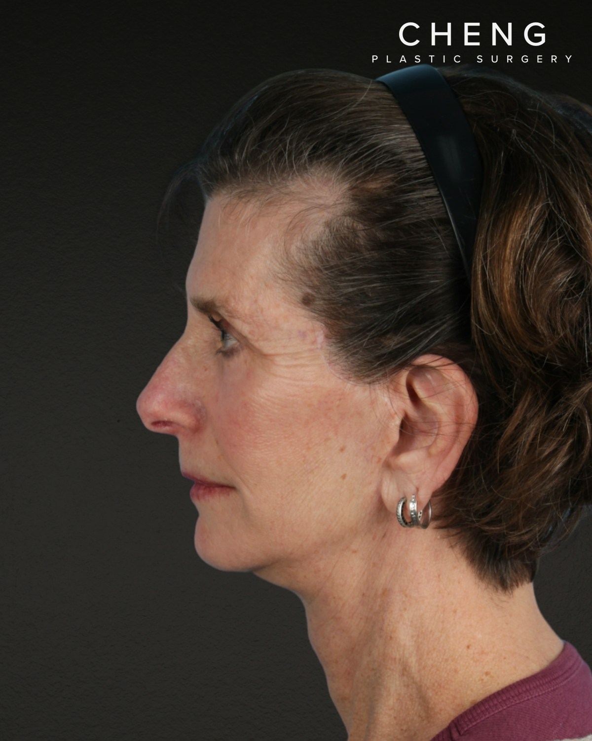 Neck Lift Before & After Gallery - Patient 180677 - Image 10