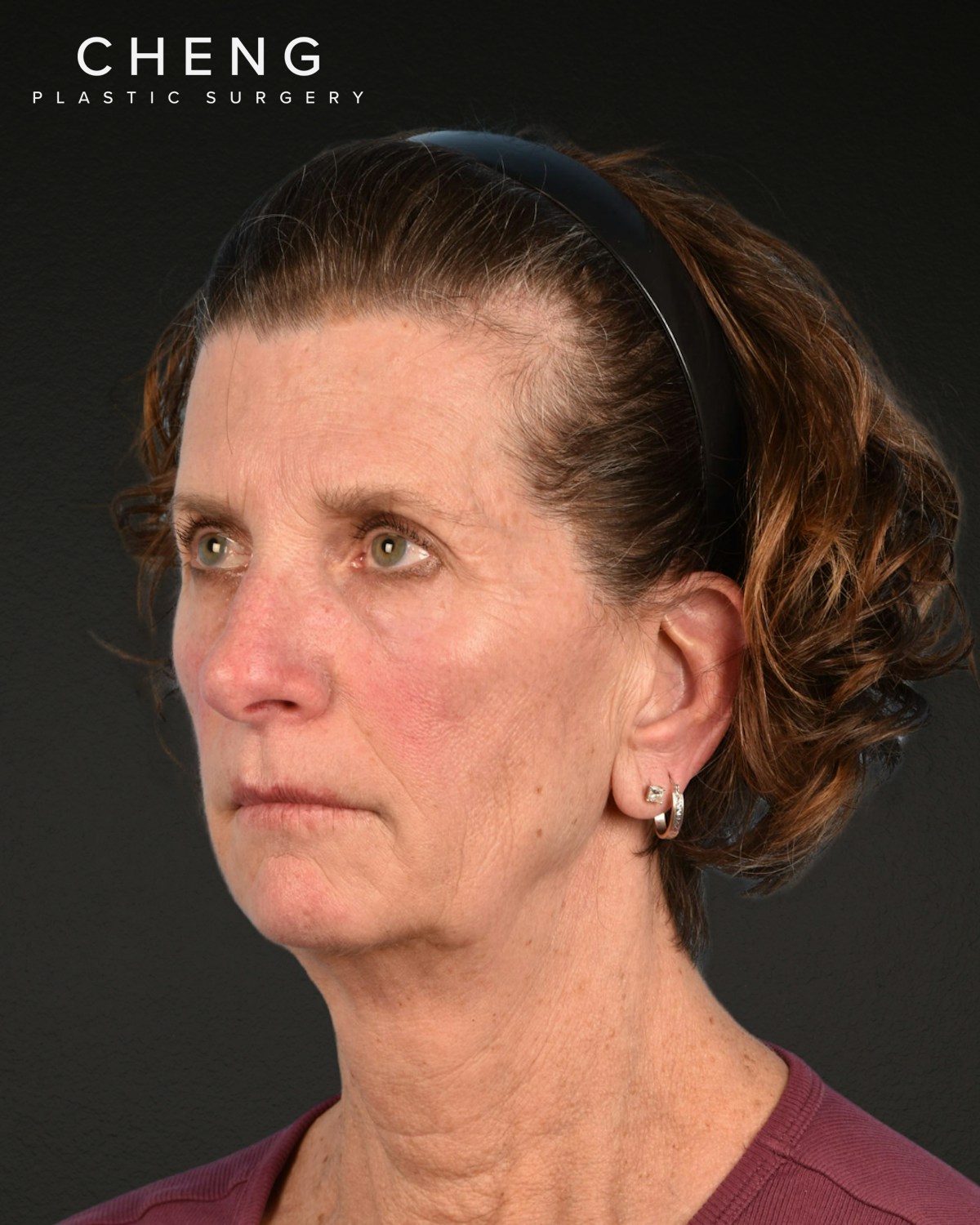 Neck Lift Before & After Gallery - Patient 180677 - Image 7