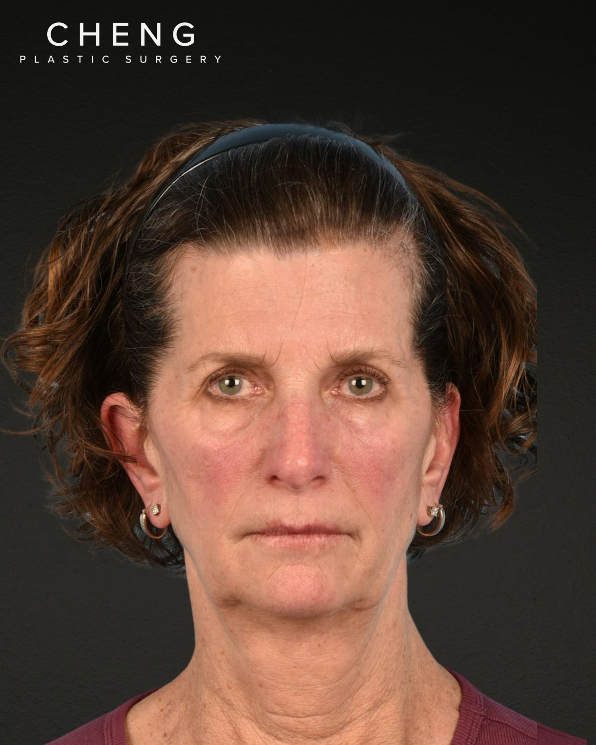 Neck Lift Before & After Gallery - Patient 180677 - Image 1