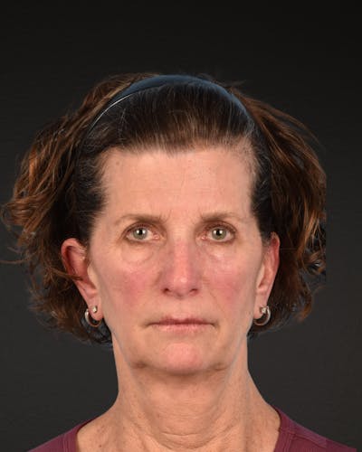 Neck Lift Before & After Gallery - Patient 180677 - Image 1