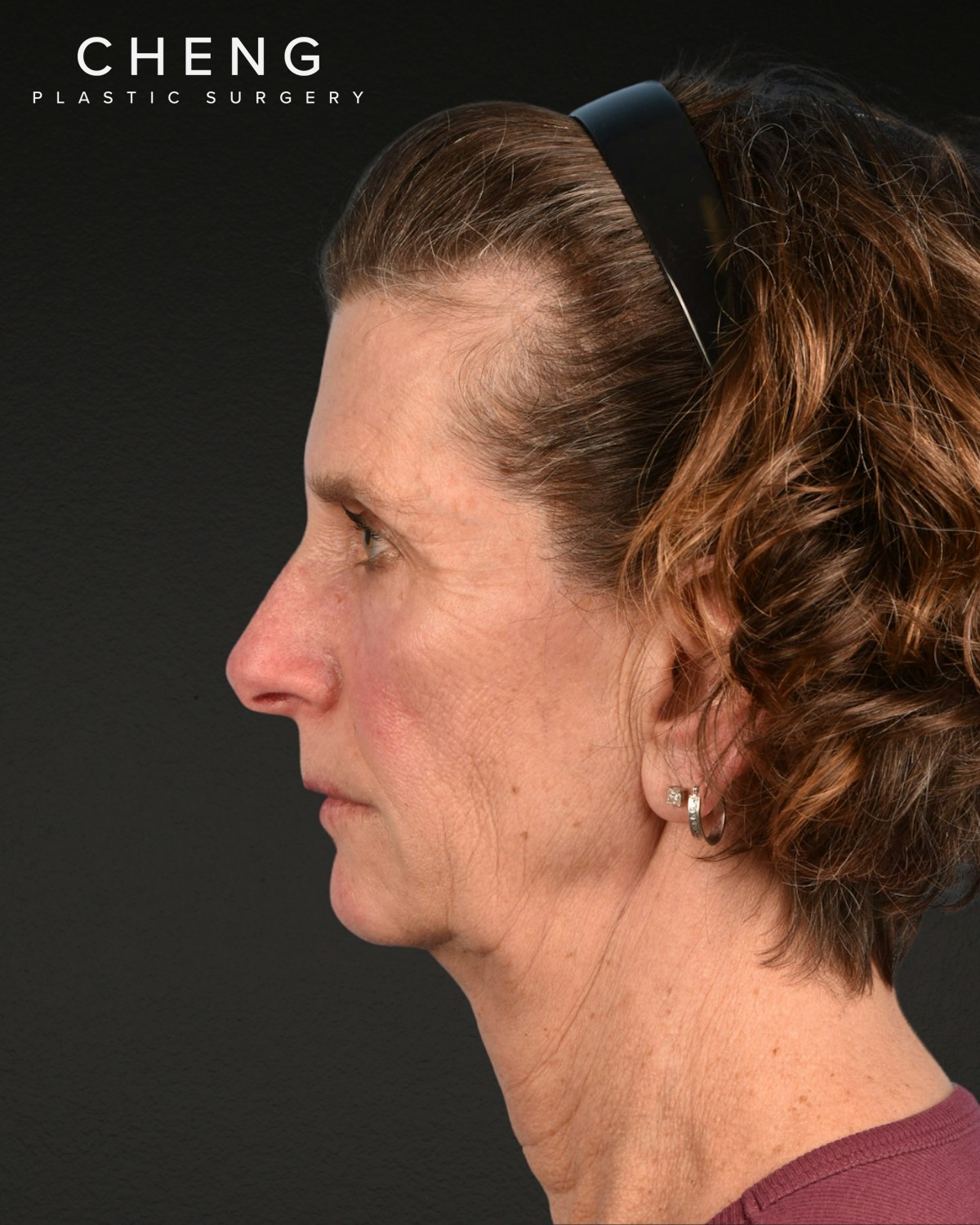 Neck Lift Before & After Gallery - Patient 180677 - Image 9