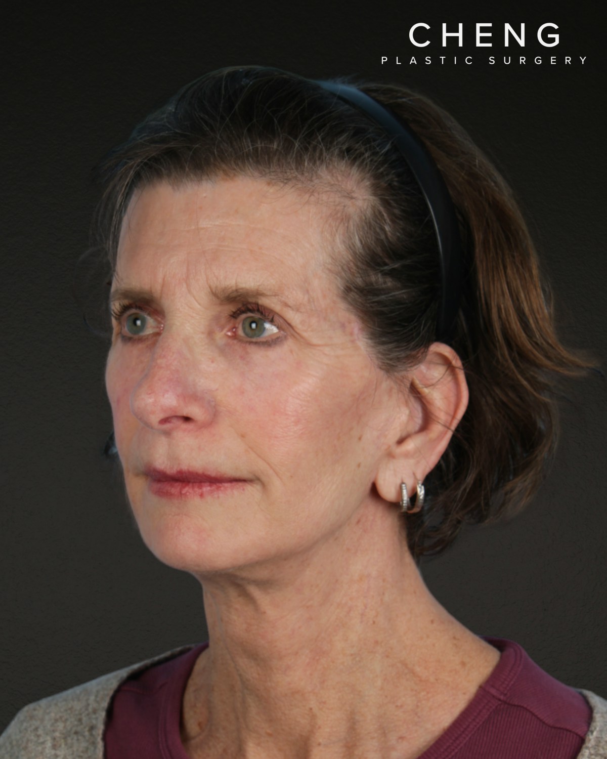 Neck Lift Before & After Gallery - Patient 180677 - Image 8