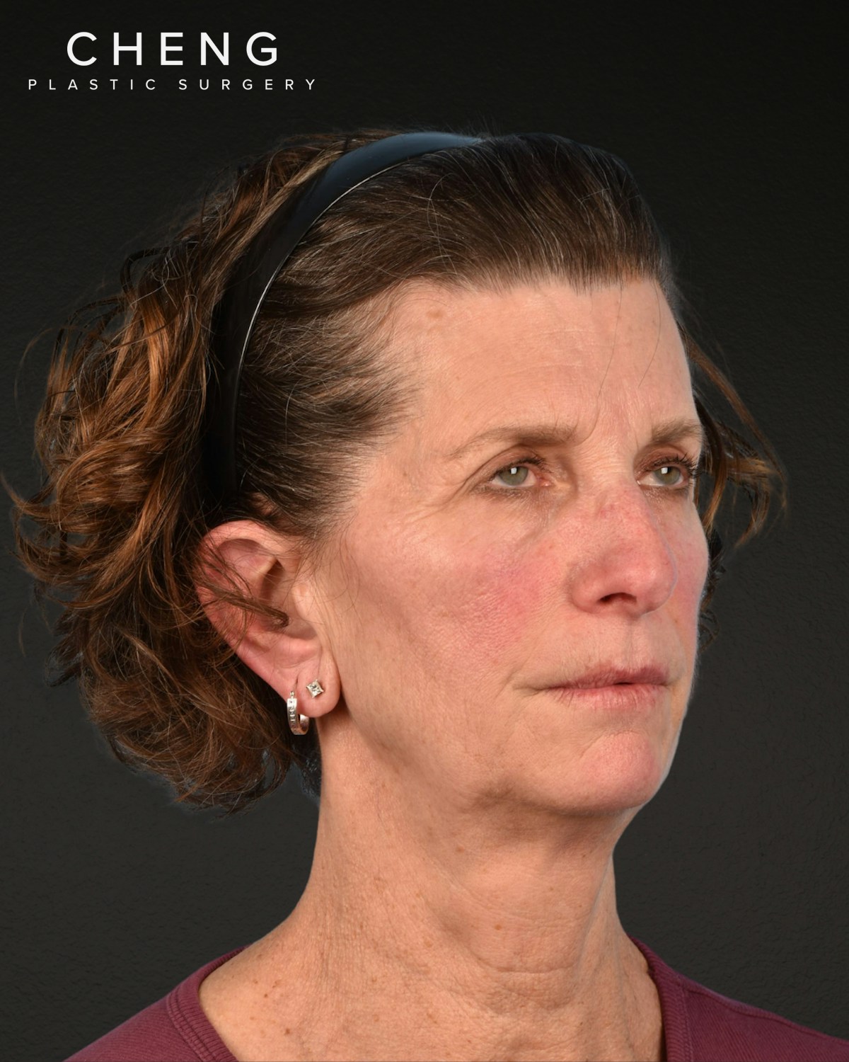 Neck Lift Before & After Gallery - Patient 180677 - Image 3