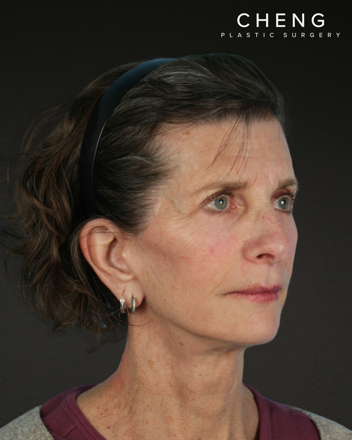 Neck Lift Before & After Gallery - Patient 180677 - Image 4