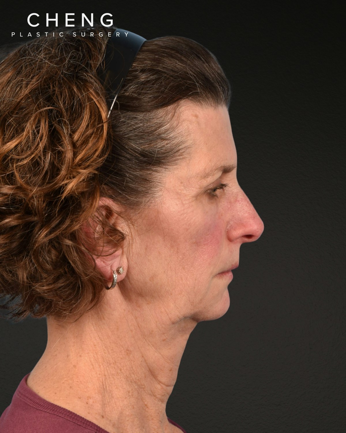Neck Lift Before & After Gallery - Patient 180677 - Image 5
