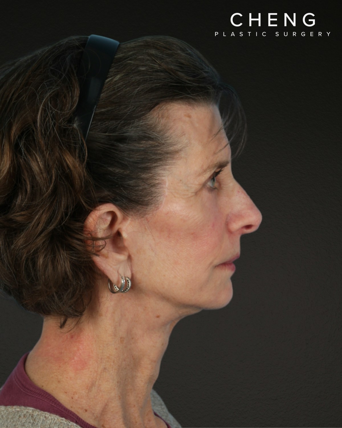 Neck Lift Before & After Gallery - Patient 180677 - Image 6