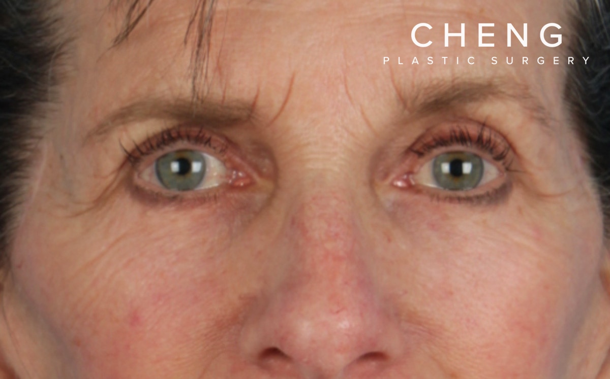 Blepharoplasty Before & After Gallery - Patient 364311 - Image 2