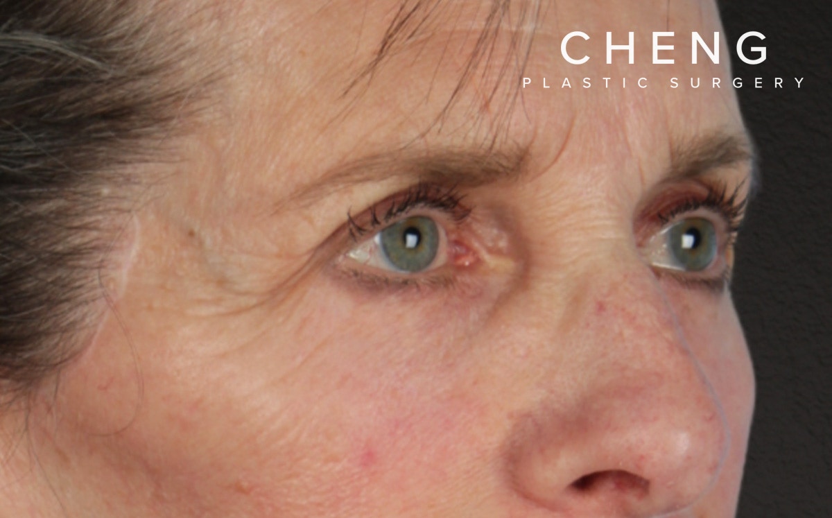 Blepharoplasty Before & After Gallery - Patient 364311 - Image 4