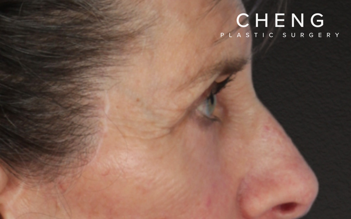 Blepharoplasty Before & After Gallery - Patient 364311 - Image 6