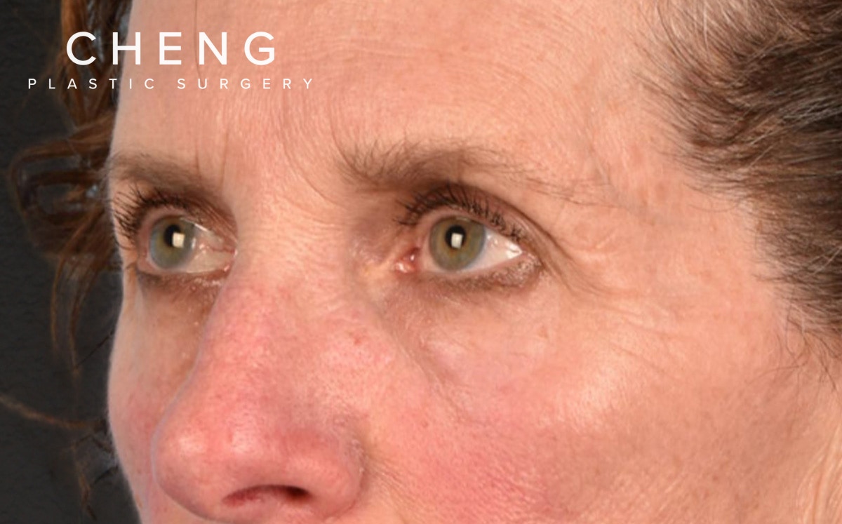 Blepharoplasty Before & After Gallery - Patient 364311 - Image 7