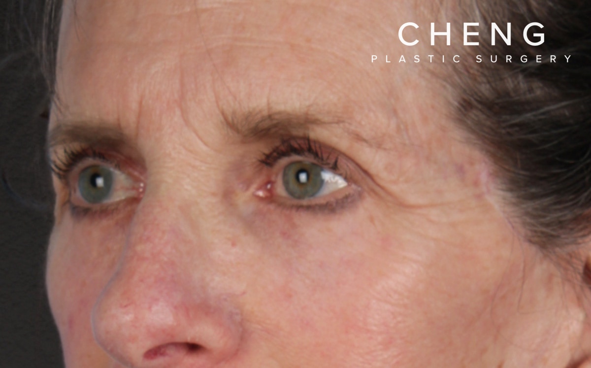 Blepharoplasty Before & After Gallery - Patient 364311 - Image 8