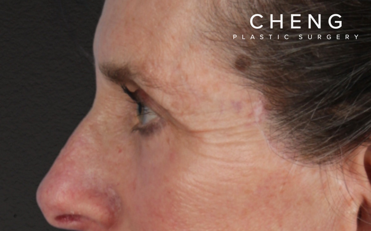 Blepharoplasty Before & After Gallery - Patient 364311 - Image 10