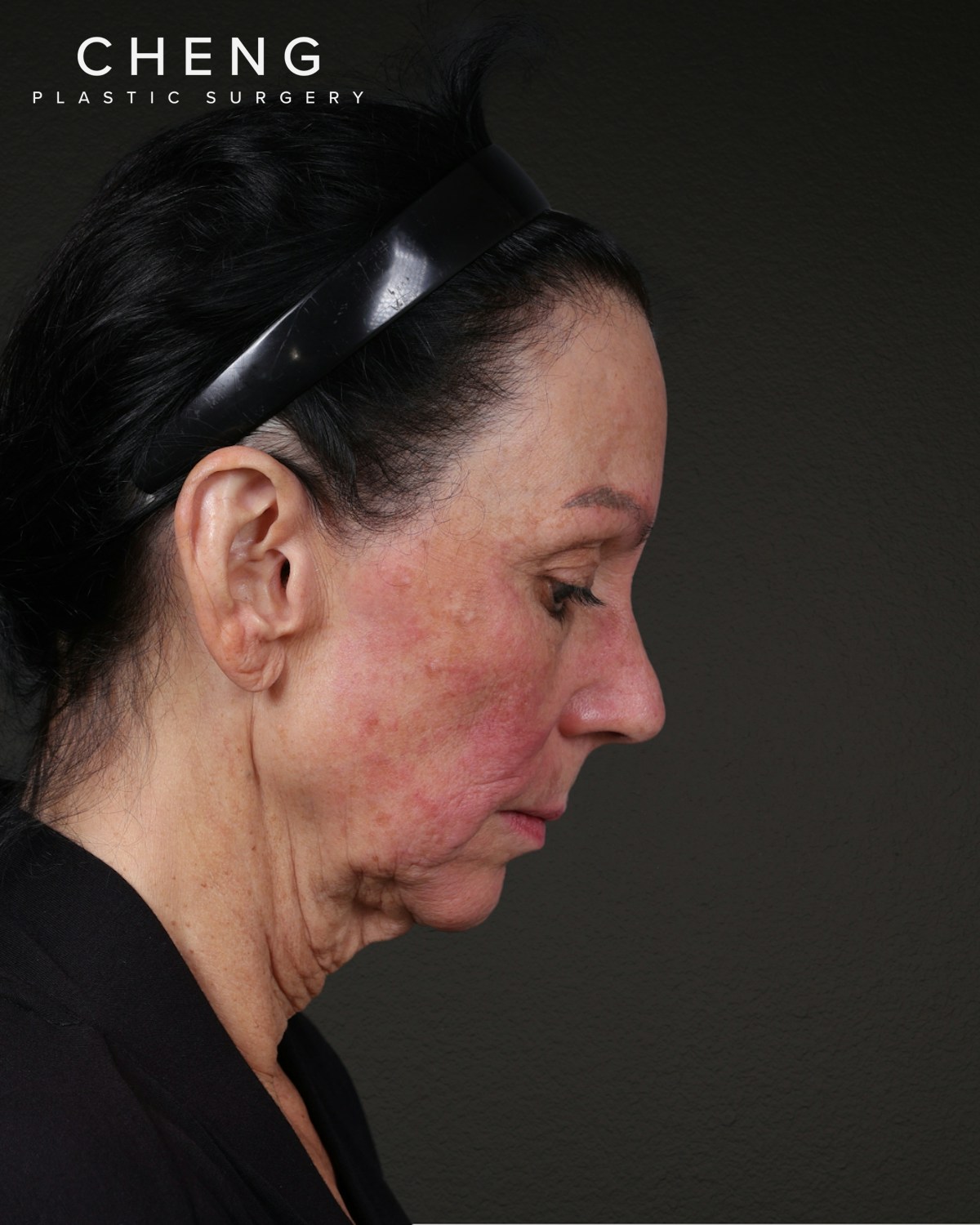 Facelift Before & After Gallery - Patient 199753 - Image 5