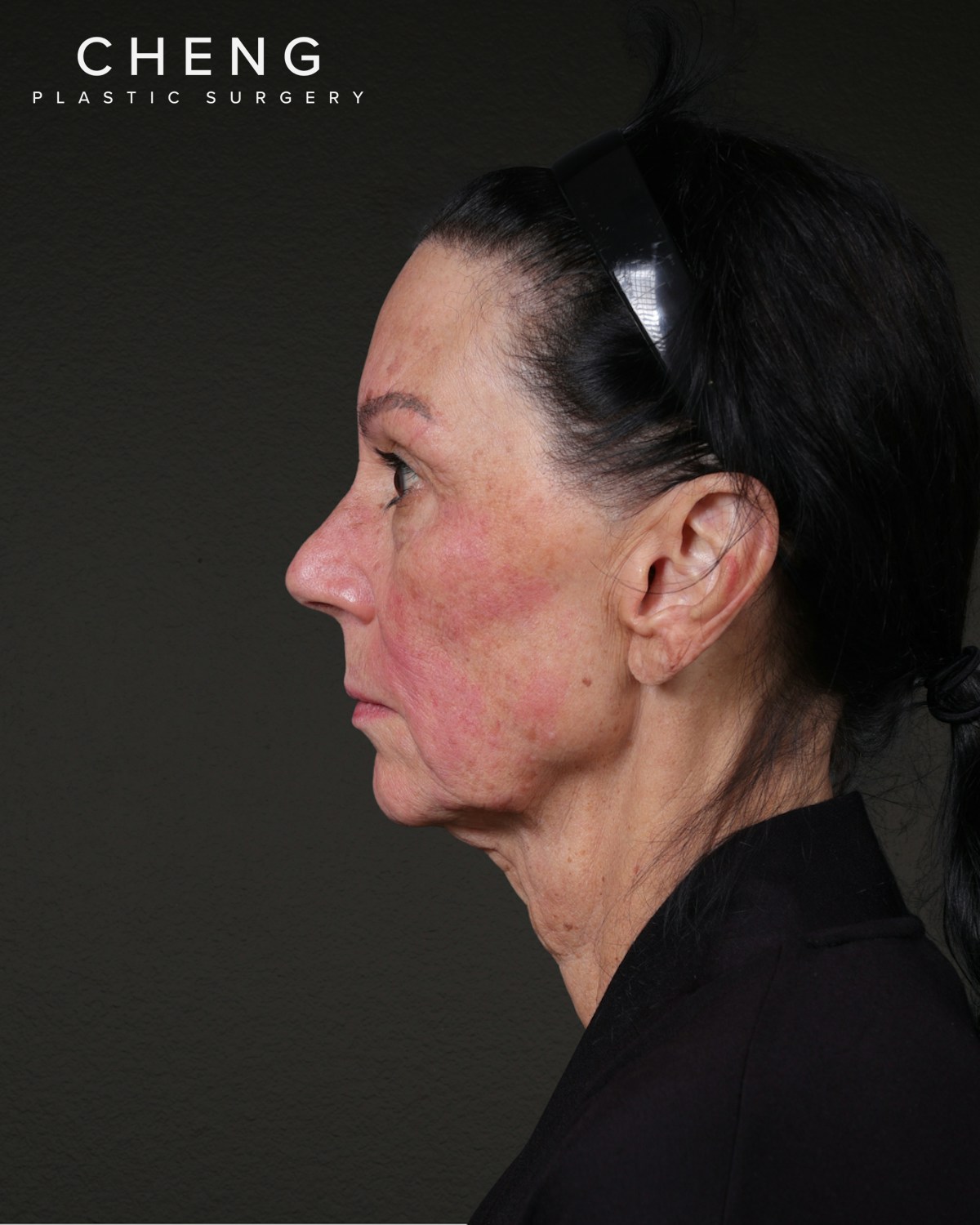 Facelift Before & After Gallery - Patient 199753 - Image 3