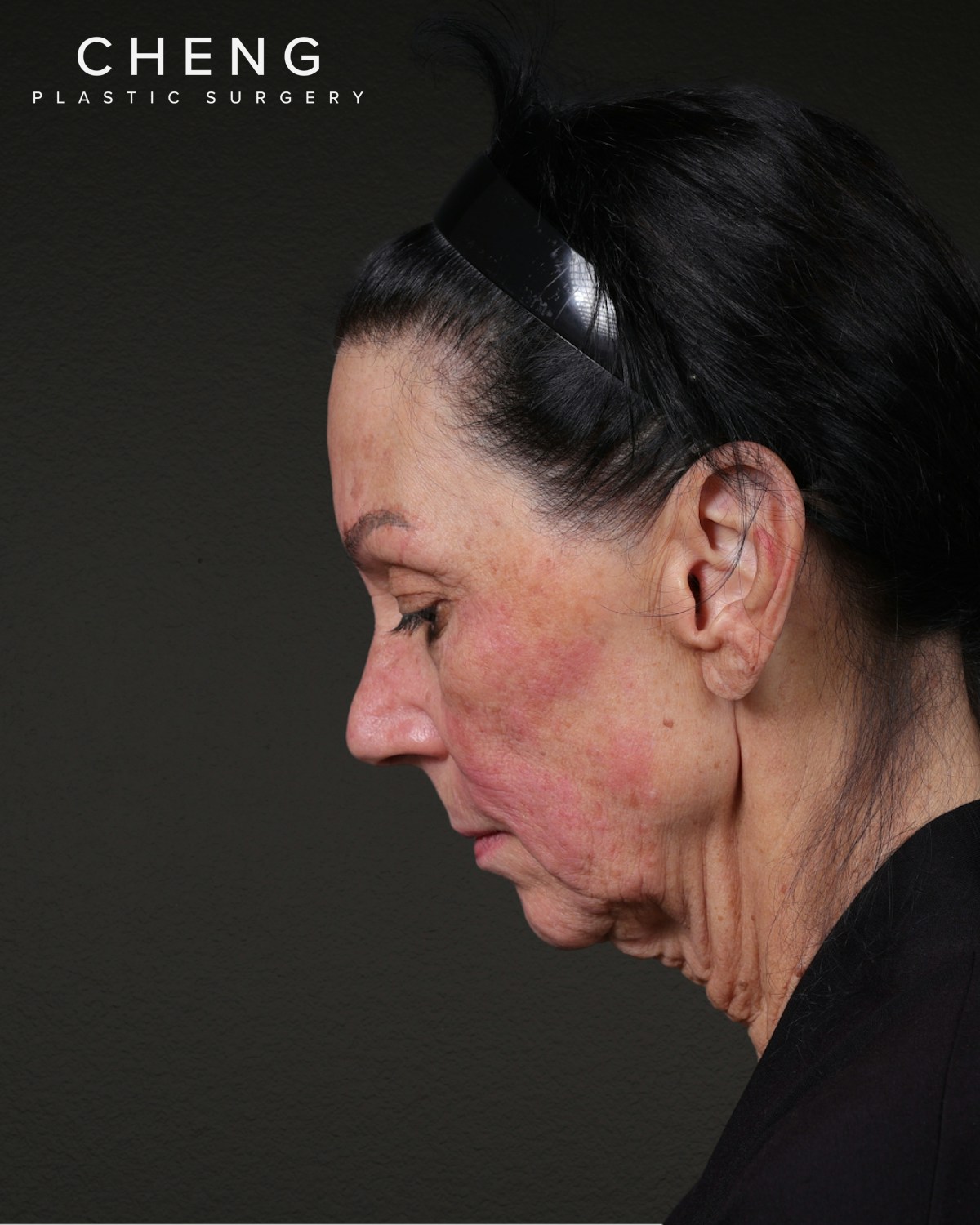 Facelift Before & After Gallery - Patient 199753 - Image 1