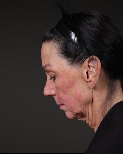 Neck Lift Before & After Gallery - Patient 255571 - Image 1