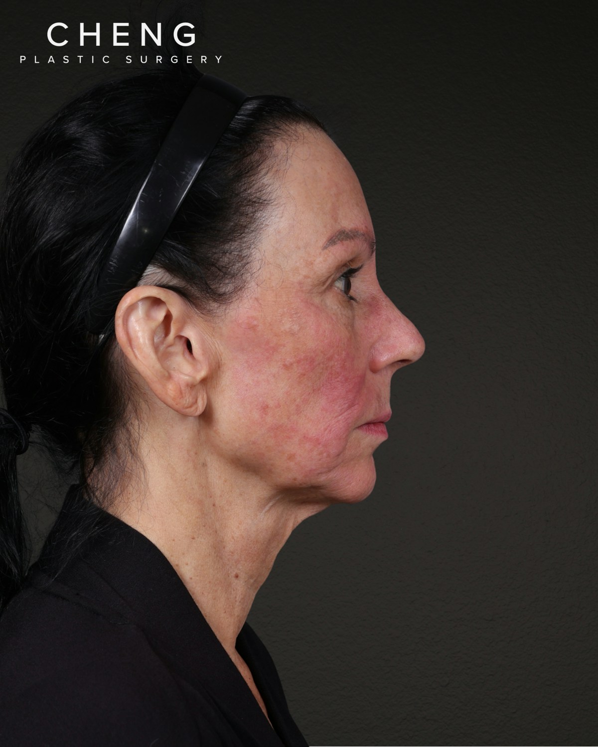 Facelift Before & After Gallery - Patient 199753 - Image 7