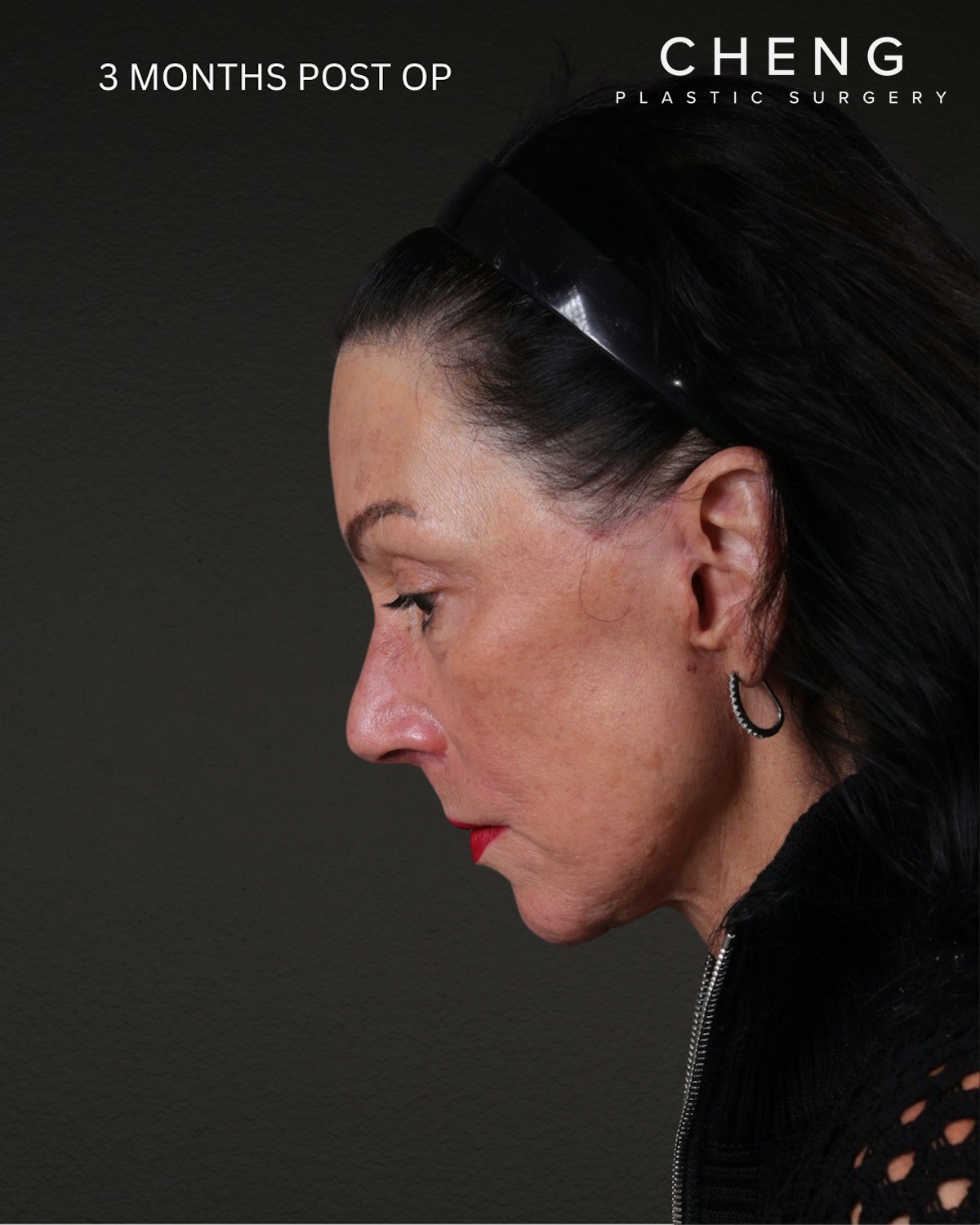 Facelift Before & After Gallery - Patient 199753 - Image 2