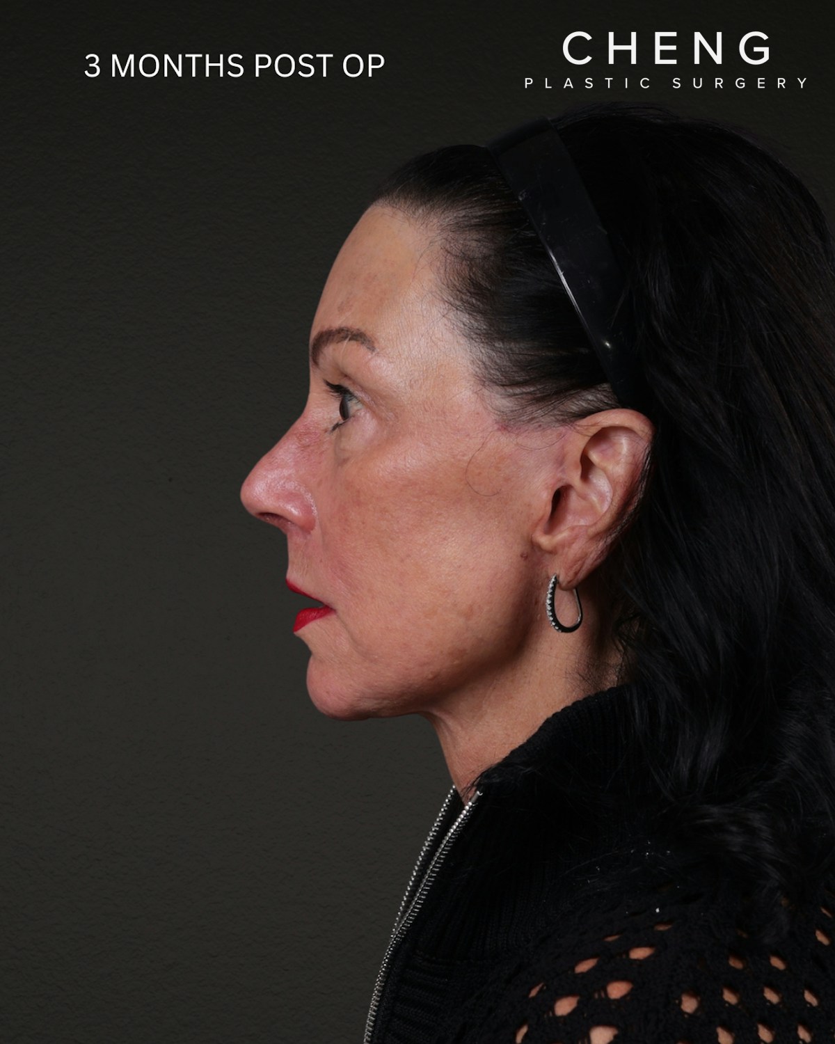 Facelift Before & After Gallery - Patient 199753 - Image 4