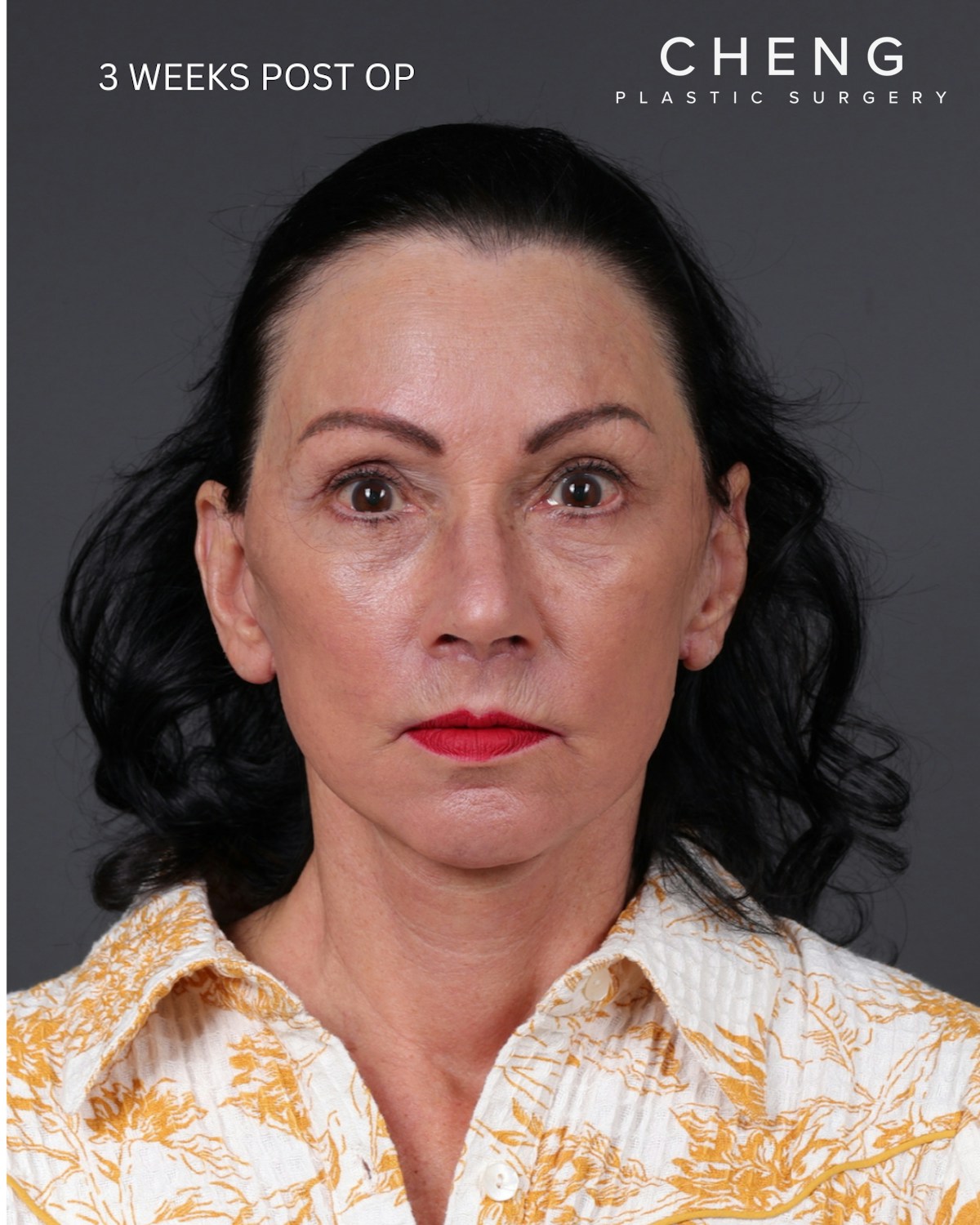 Facelift Before & After Gallery - Patient 199753 - Image 10