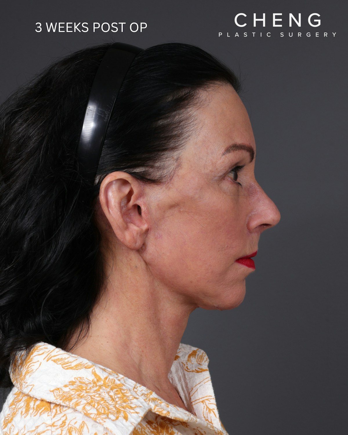 Facelift Before & After Gallery - Patient 199753 - Image 14