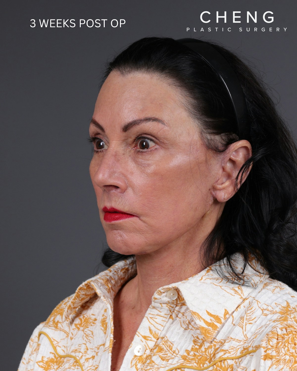Facelift Before & After Gallery - Patient 199753 - Image 16