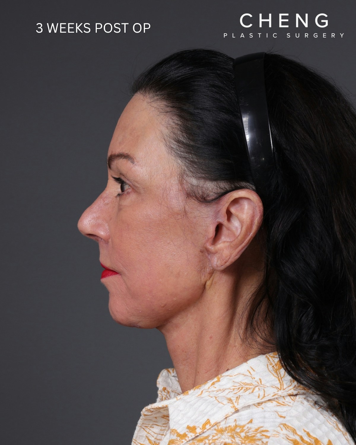 Facelift Before & After Gallery - Patient 199753 - Image 18