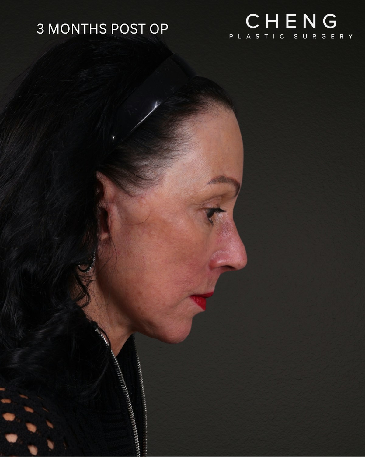 Facelift Before & After Gallery - Patient 199753 - Image 6