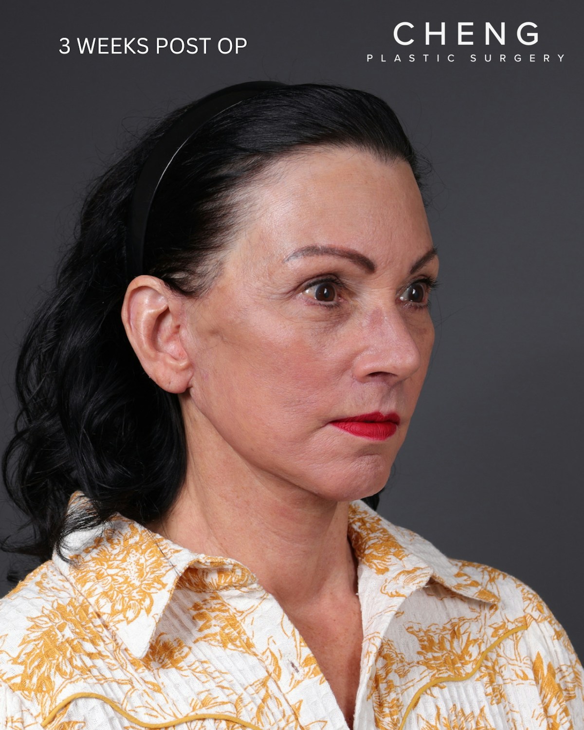 Facelift Before & After Gallery - Patient 199753 - Image 12