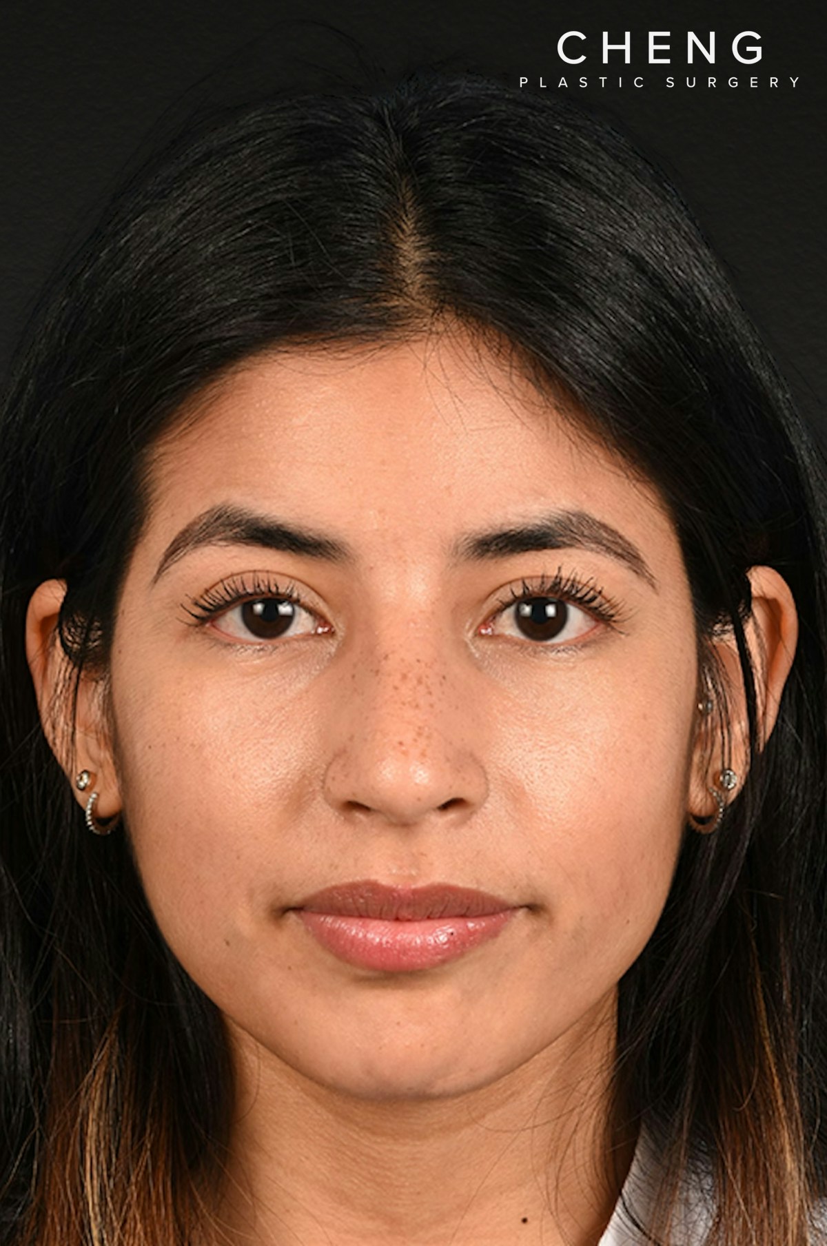 Rhinoplasty Before & After Gallery - Patient 428815 - Image 6
