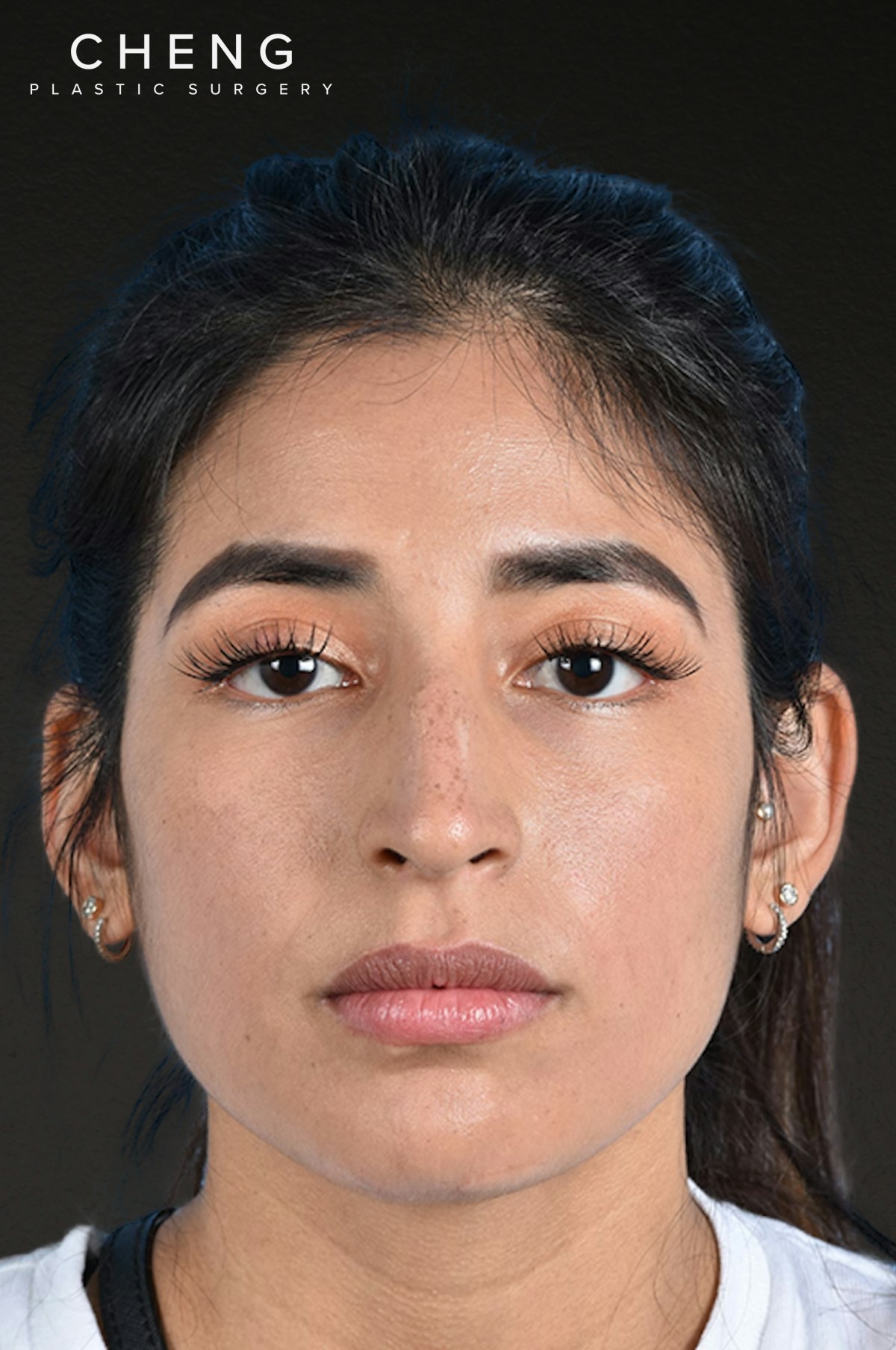Rhinoplasty Before & After Gallery - Patient 428815 - Image 5