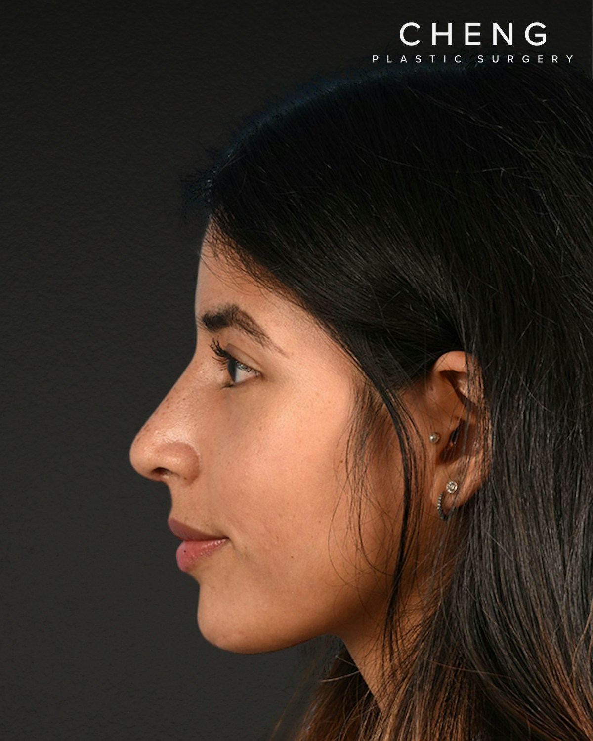 Rhinoplasty Before & After Gallery - Patient 428815 - Image 10