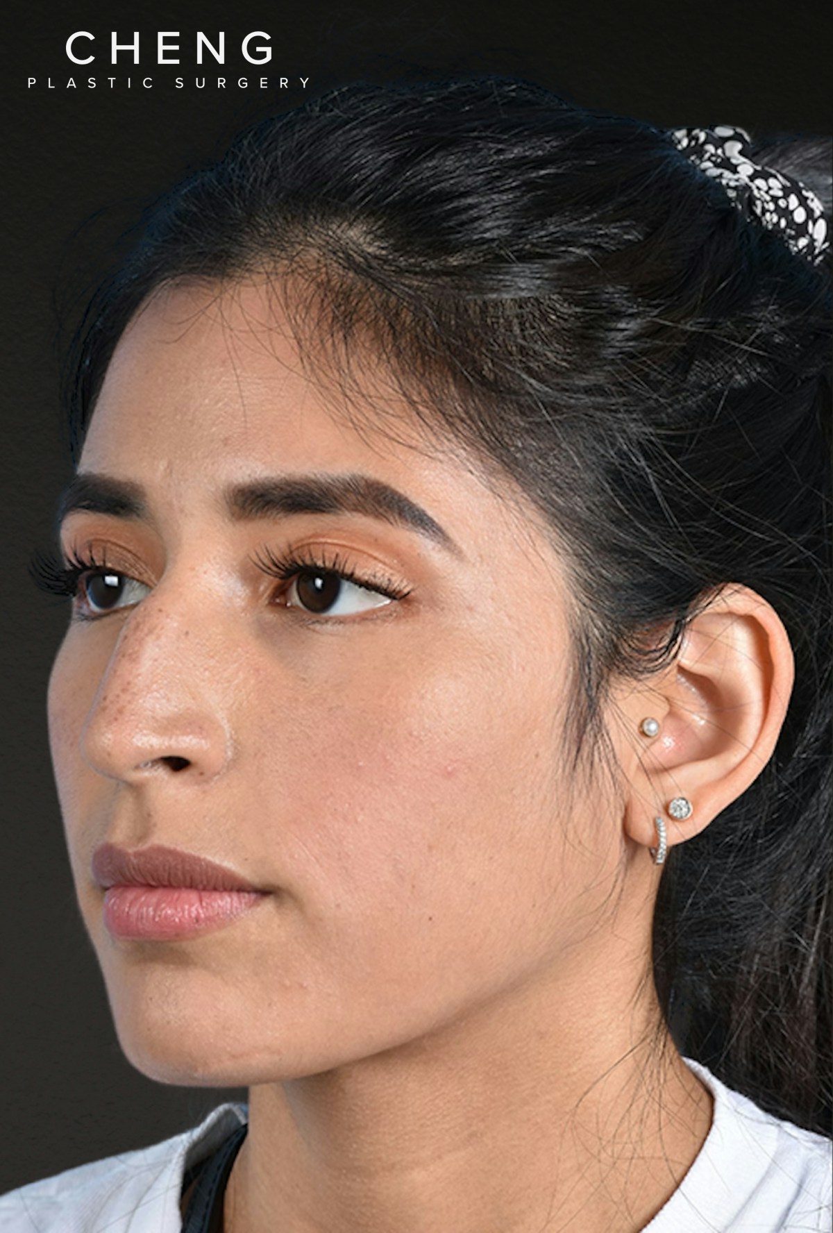 Rhinoplasty Before & After Gallery - Patient 428815 - Image 7