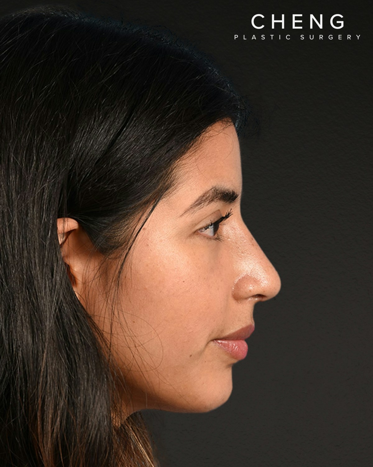 Rhinoplasty Before & After Gallery - Patient 428815 - Image 2