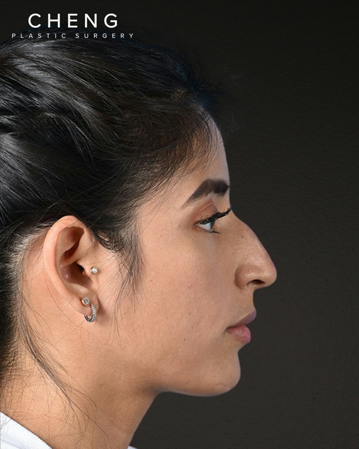 Rhinoplasty Before & After Gallery - Patient 428815 - Image 1