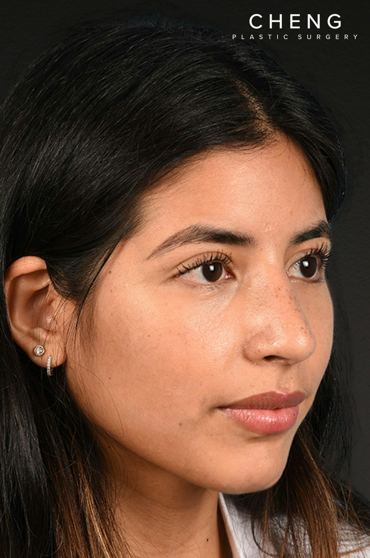 Rhinoplasty Before & After Gallery - Patient 428815 - Image 4