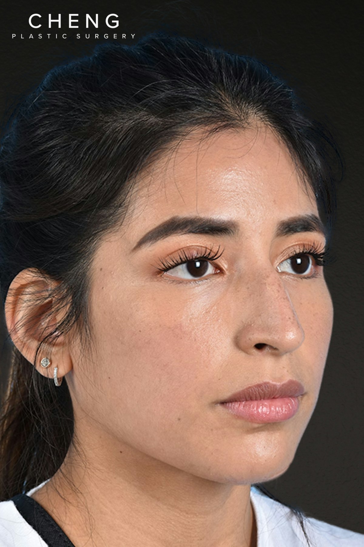 Rhinoplasty Before & After Gallery - Patient 428815 - Image 3