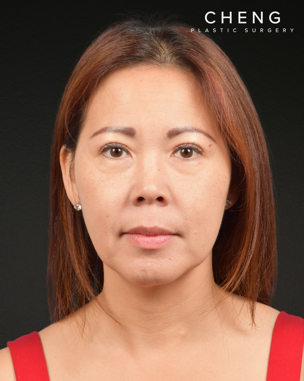 Facelift Before & After Gallery - Patient 384291 - Image 2