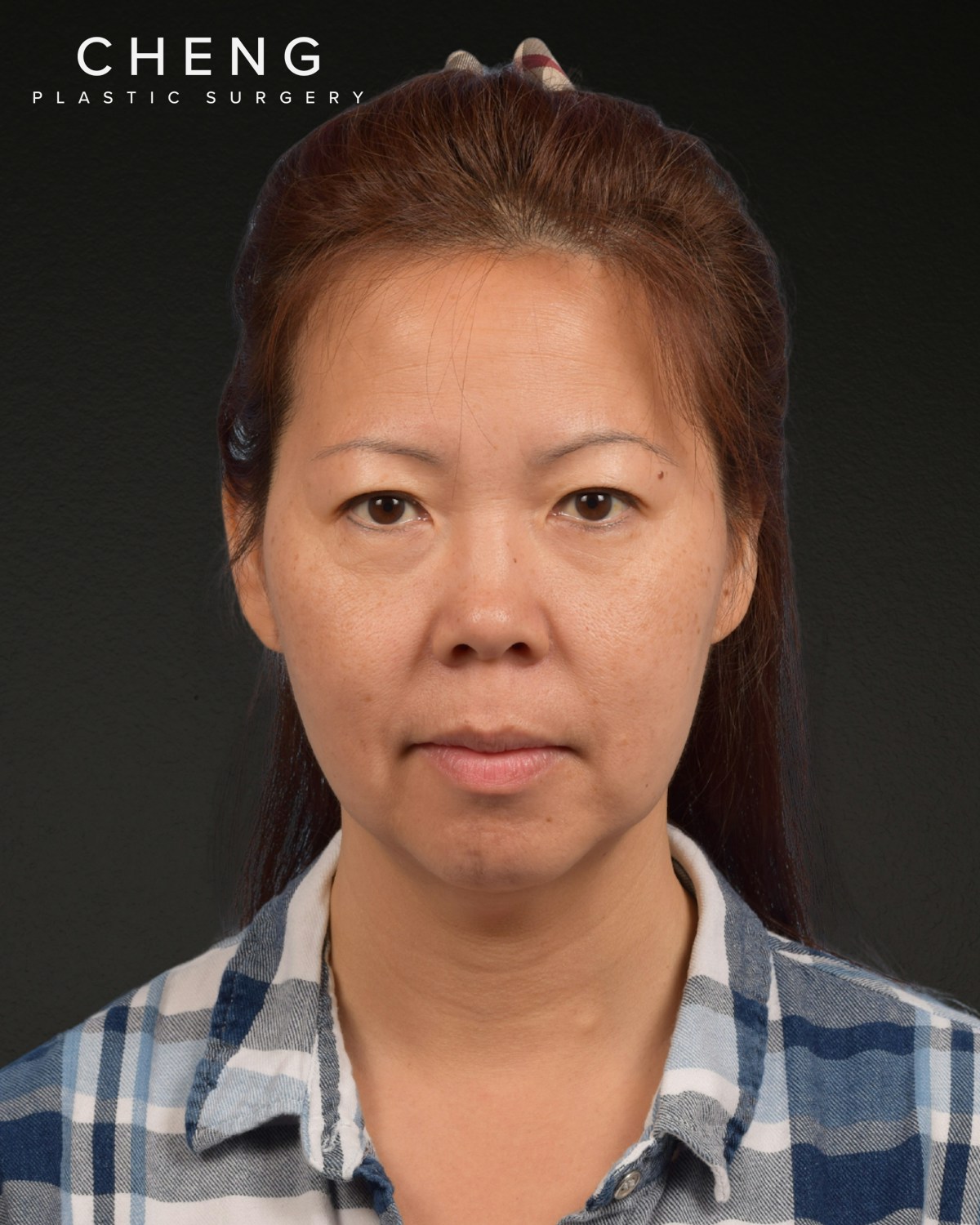 Facelift Before & After Gallery - Patient 384291 - Image 1