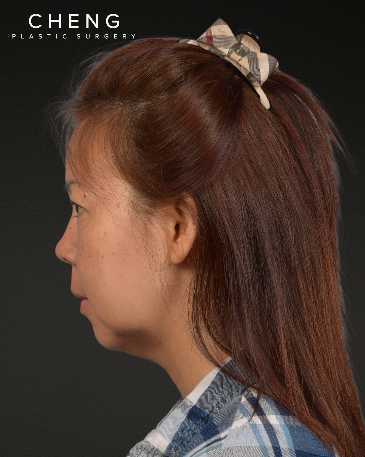 Facelift Before & After Gallery - Patient 384291 - Image 9