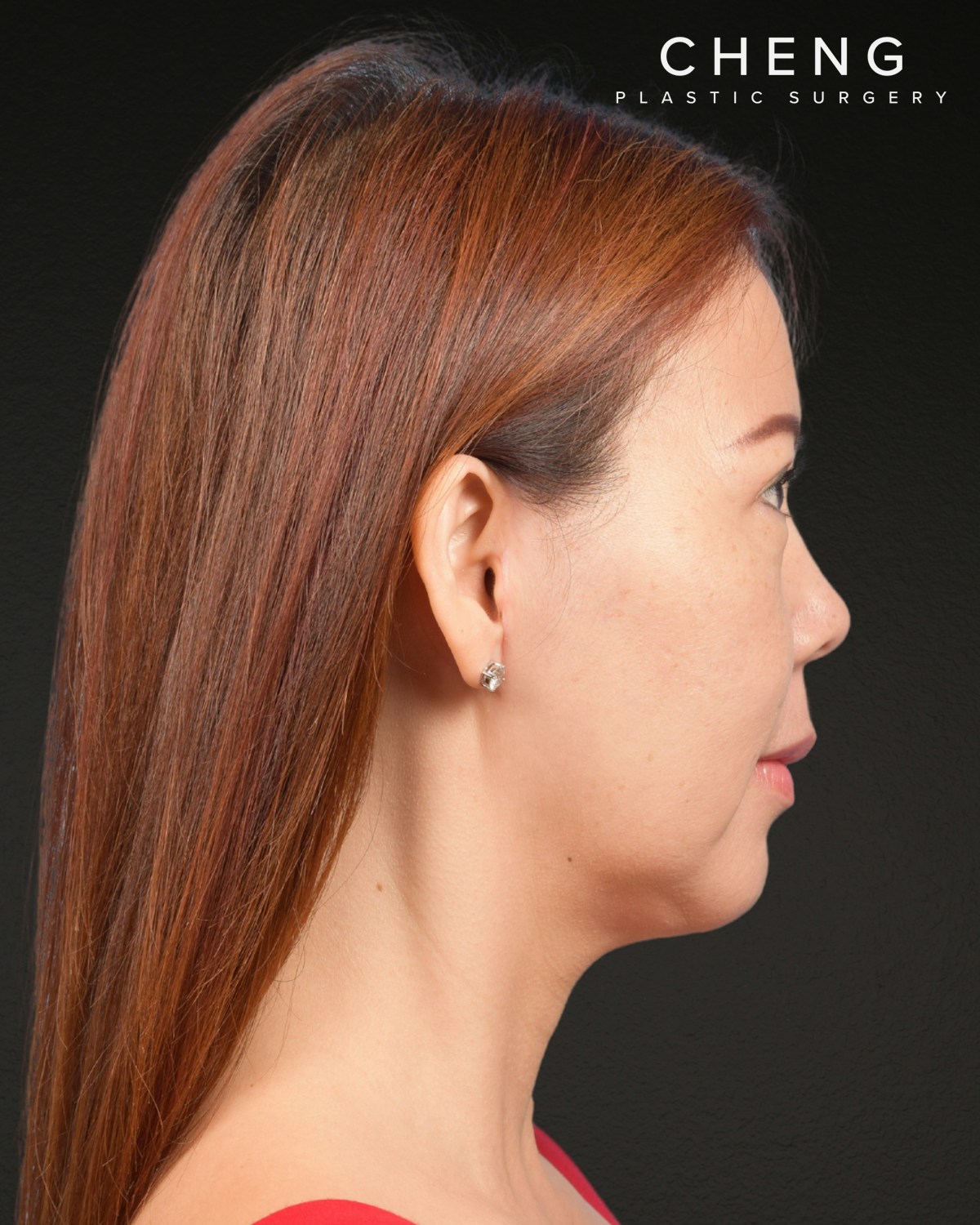 Facelift Before & After Gallery - Patient 384291 - Image 6