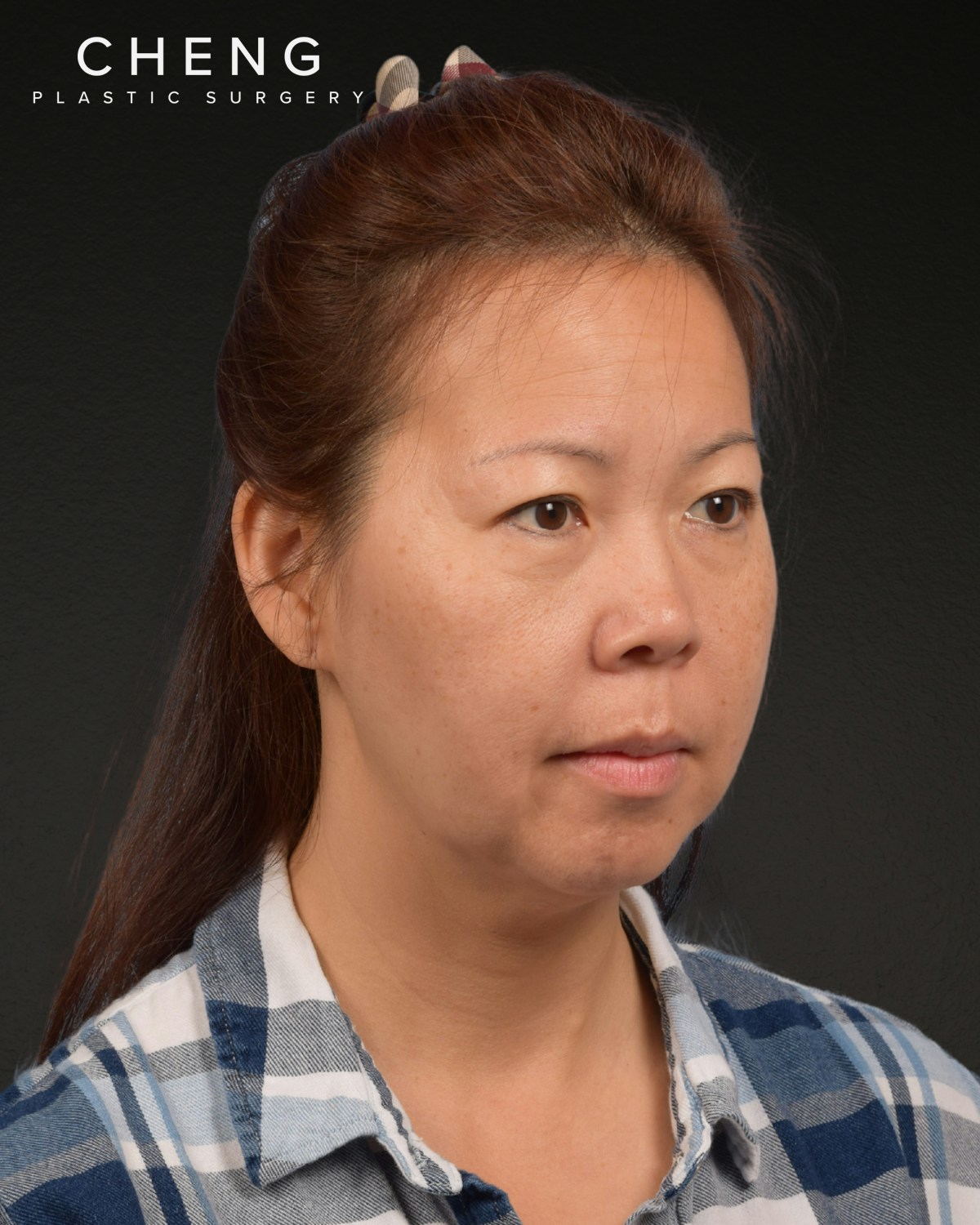 Facelift Before & After Gallery - Patient 384291 - Image 3