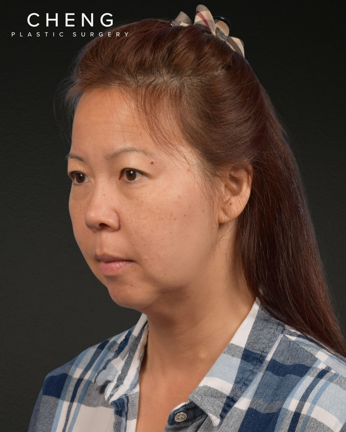 Facelift Before & After Gallery - Patient 384291 - Image 7
