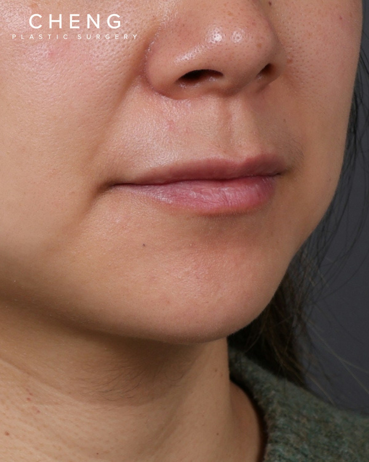 Dermal Fillers Before & After Gallery - Patient 206577 - Image 3