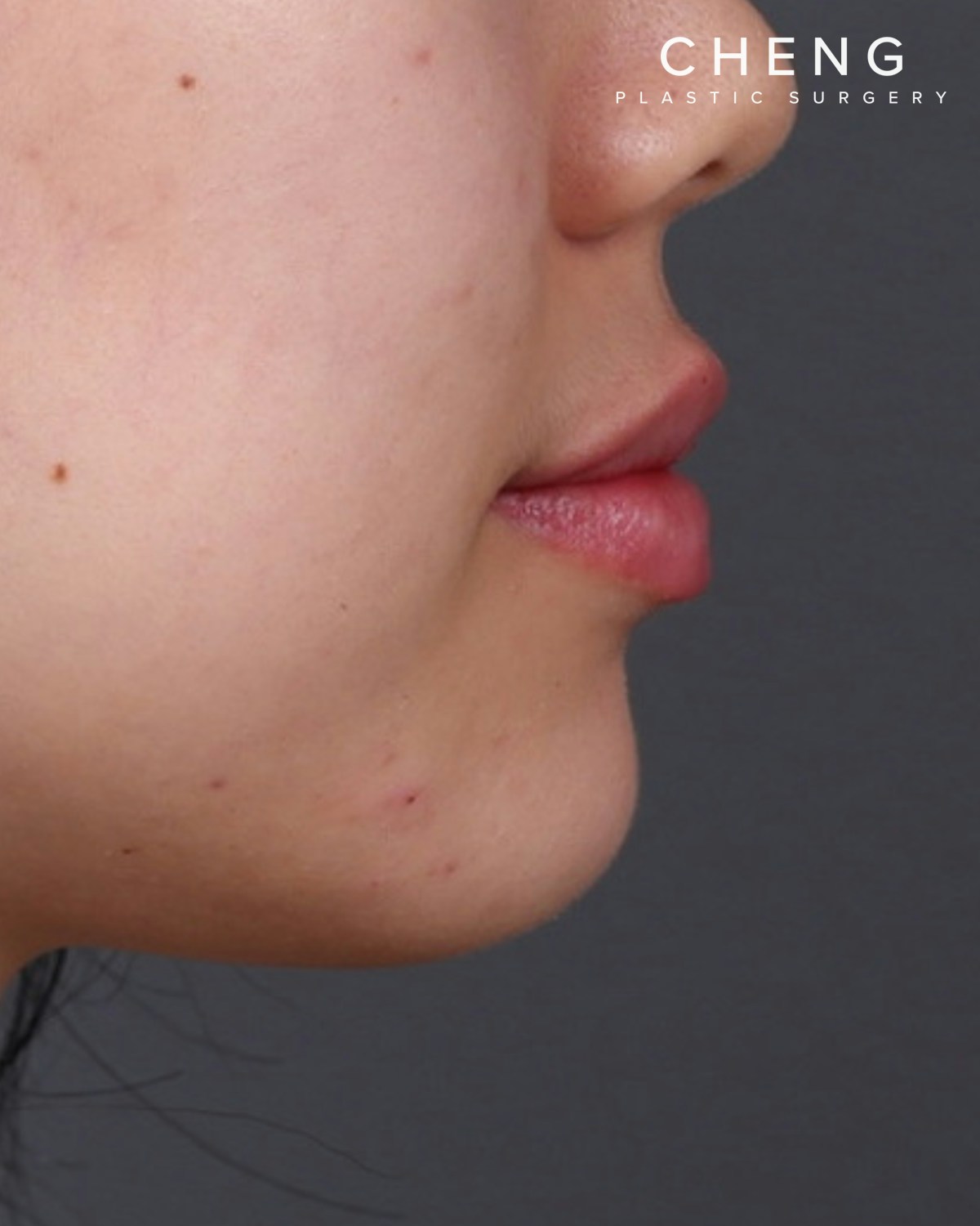 Dermal Fillers Before & After Gallery - Patient 377909 - Image 6